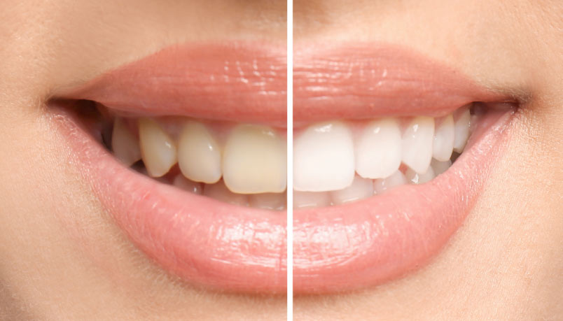 Teeth Whitening Before and After Results 2